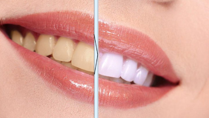 Tandenbleekpen Verwijder tandplak en tandsteen Reinig de mond Tandenpoetsen